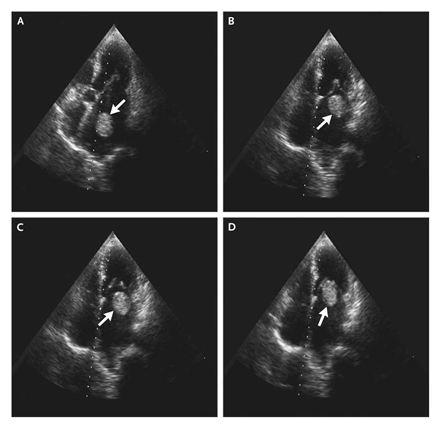 coumadin alternative for atrial fibrillation